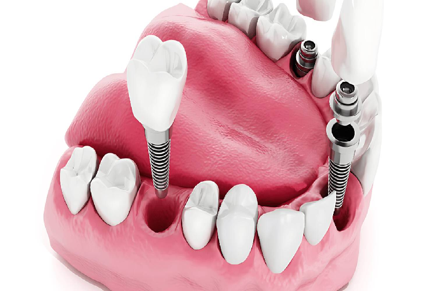 innovations shaping the future of dental implant treatments